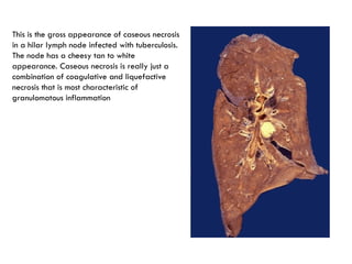 This is the gross appearance of caseous necrosis
in a hilar lymph node infected with tuberculosis.
The node has a cheesy tan to white
appearance. Caseous necrosis is really just a
combination of coagulative and liquefactive
necrosis that is most characteristic of
granulomatous inflammation
 