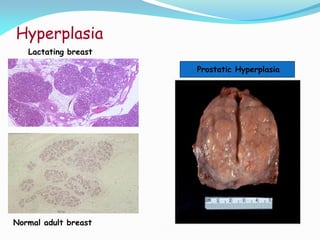 Hyperplasia
Normal adult breast
Lactating breast
Prostatic Hyperplasia
 