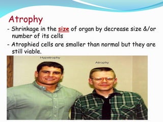 Atrophy
- Shrinkage in the size of organ by decrease size &/or
number of its cells
- Atrophied cells are smaller than normal but they are
still viable.
 
