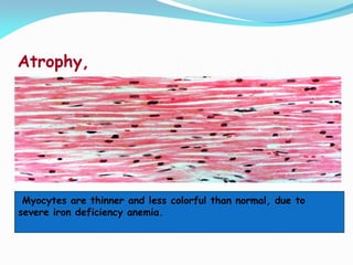 Atrophy,
Myocytes are thinner and less colorful than normal, due to
severe iron deficiency anemia.
 