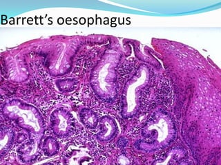 Barrett’s oesophagus
 