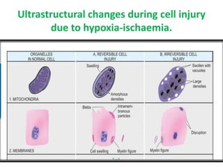 Ultrastructural changes during cell injury
due to hypoxia-ischaemia.
 