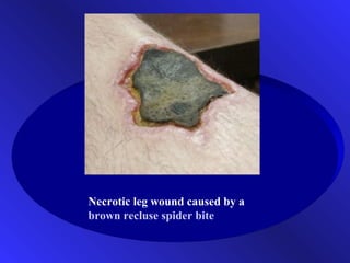 Necrotic leg wound caused by a
brown recluse spider bite
 