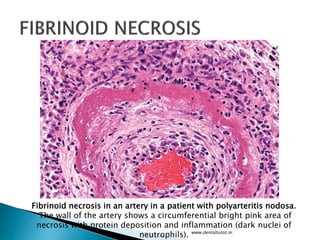 www.dentaltutot.in
Fibrinoid necrosis in an artery in a patient with polyarteritis nodosa.
The wall of the artery shows a circumferential bright pink area of
necrosis with protein deposition and inflammation (dark nuclei of
neutrophils).
 