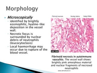  Microscopically
◦ identified by brightly
eosinophilic, hyaline-like
deposition in the vessel
wall.
◦ Necrotic focus is
surrounded by nuclear
debris of neutrophils
(leucocytoclasis)
◦ Local haemorrhage may
occur due to rupture of the
blood vessel.
www.dentaltutot.in
Fibrinoid necrosis in autoimmune
vasculitis. The vessel wall shows
brightly pink amorphous material
and nuclear fragments of necrosed
neutrophils
 