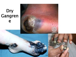 Dry gangrene
www.dentaltutot.in
Dry
Gangren
e
 