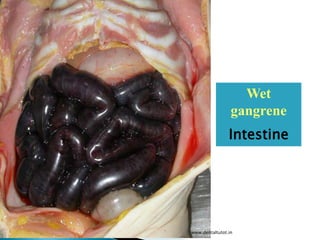 Wet
gangrene
Intestine
www.dentaltutot.in
 