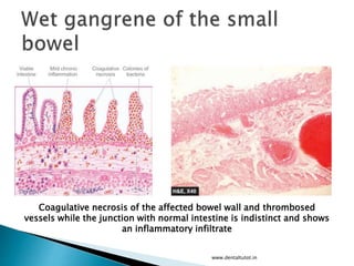 www.dentaltutot.in
Coagulative necrosis of the affected bowel wall and thrombosed
vessels while the junction with normal intestine is indistinct and shows
an inflammatory infiltrate
 