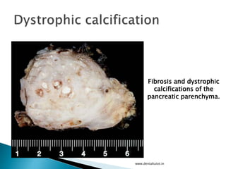 www.dentaltutot.in
Fibrosis and dystrophic
calcifications of the
pancreatic parenchyma.
 