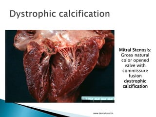 www.dentaltutot.in
Mitral Stenosis:
Gross natural
color opened
valve with
commissure
fusion
dystrophic
calcification
 