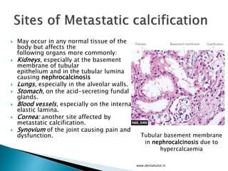  May occur in any normal tissue of the
body but affects the
following organs more commonly:
 Kidneys, especially at the basement
membrane of tubular
epithelium and in the tubular lumina
causing nephrocalcinosis
 Lungs, especially in the alveolar walls.
 Stomach, on the acid-secreting fundal
glands.
 Blood vessels, especially on the internal
elastic lamina.
 Cornea: another site affected by
metastatic calcification.
 Synovium of the joint causing pain and
dysfunction.
www.dentaltutot.in
Tubular basement membrane
in nephrocalcinosis due to
hypercalcaemia
 
