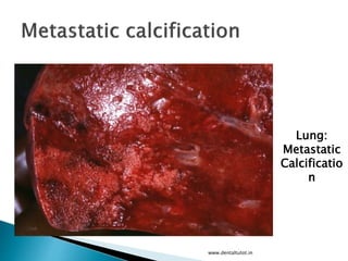 www.dentaltutot.in
Lung:
Metastatic
Calcificatio
n
 