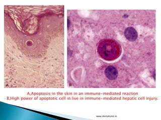 A,Apoptosis in the skin in an immune-mediated reaction
B,High power of apoptotic cell in live in immune-mediated hepatic cell injury.
www.dentaltutot.in
 