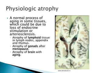  A normal process of
aging in some tissues,
which could be due to
loss of endocrine
stimulation or
arteriosclerosis.
◦ Atrophy of lymphoid tissue
in lymph nodes, appendix
and thymus.
◦ Atrophy of gonads after
menopause.
◦ Atrophy of brain with
aging.
www.dentaltutot.in
 