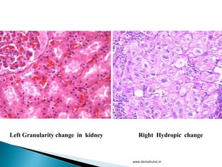 Left Granularity change in kidney Right Hydropic change
www.dentaltutot.in
 