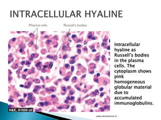 www.dentaltutot.in
Intracellular
hyaline as
Russell’s bodies
in the plasma
cells. The
cytoplasm shows
pink
homogeneous
globular material
due to
accumulated
immunoglobulins.
 