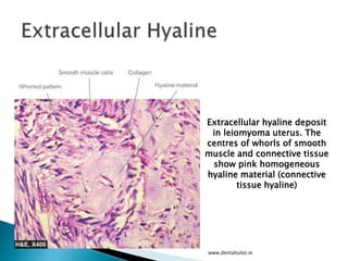 www.dentaltutot.in
Extracellular hyaline deposit
in leiomyoma uterus. The
centres of whorls of smooth
muscle and connective tissue
show pink homogeneous
hyaline material (connective
tissue hyaline)
 