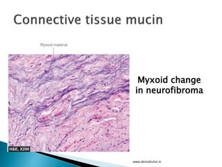 www.dentaltutot.in
Myxoid change
in neurofibroma
 