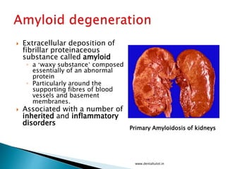  Extracellular deposition of
fibrillar proteinaceous
substance called amyloid
◦ a ‘waxy substance’ composed
essentially of an abnormal
protein
◦ Particularly around the
supporting fibres of blood
vessels and basement
membranes.
 Associated with a number of
inherited and inflammatory
disorders
www.dentaltutot.in
Primary Amyloidosis of kidneys
 