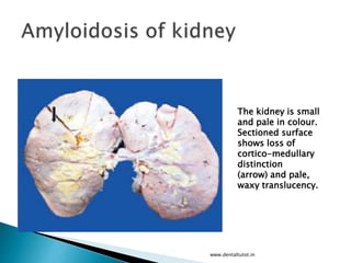 www.dentaltutot.in
The kidney is small
and pale in colour.
Sectioned surface
shows loss of
cortico-medullary
distinction
(arrow) and pale,
waxy translucency.
 