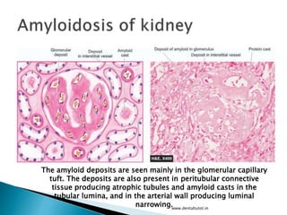 www.dentaltutot.in
The amyloid deposits are seen mainly in the glomerular capillary
tuft. The deposits are also present in peritubular connective
tissue producing atrophic tubules and amyloid casts in the
tubular lumina, and in the arterial wall producing luminal
narrowing.
 