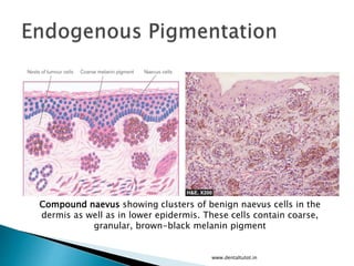 www.dentaltutot.in
Compound naevus showing clusters of benign naevus cells in the
dermis as well as in lower epidermis. These cells contain coarse,
granular, brown-black melanin pigment
 