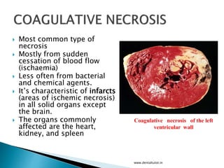  Most common type of
necrosis
 Mostly from sudden
cessation of blood flow
(ischaemia)
 Less often from bacterial
and chemical agents.
 It’s characteristic of infarcts
(areas of ischemic necrosis)
in all solid organs except
the brain.
 The organs commonly
affected are the heart,
kidney, and spleen
www.dentaltutot.in
Coagulative necrosis of the left
ventricular wall
 