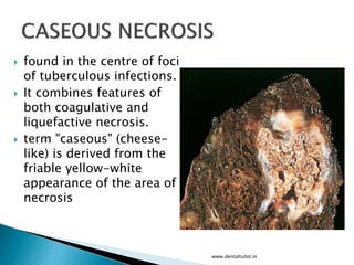  found in the centre of foci
of tuberculous infections.
 It combines features of
both coagulative and
liquefactive necrosis.
 term "caseous" (cheese-
like) is derived from the
friable yellow-white
appearance of the area of
necrosis
www.dentaltutot.in
 