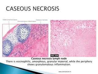 www.dentaltutot.in
Caseous necrosis lymph node
There is eosinophilic, amorphous, granular material, while the periphery
shows granulomatous inflammation.
 