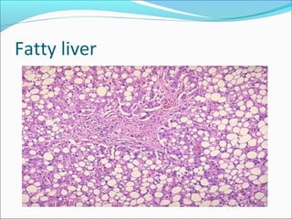 Fatty liver
 