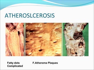 ATHEROSLCEROSIS
Fatty dots F.Atheroma Plaques
Complicated
 