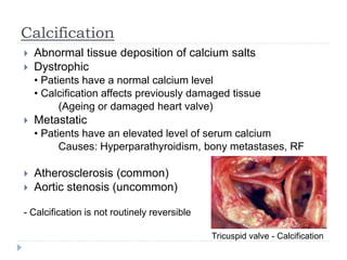 Calcification
 Abnormal tissue deposition of calcium salts
 Dystrophic
• Patients have a normal calcium level
• Calcification affects previously damaged tissue
(Ageing or damaged heart valve)
 Metastatic
• Patients have an elevated level of serum calcium
Causes: Hyperparathyroidism, bony metastases, RF
 Atherosclerosis (common)
 Aortic stenosis (uncommon)
- Calcification is not routinely reversible
Tricuspid valve - Calcification
 