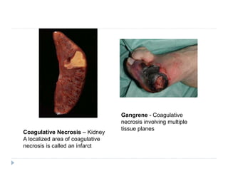 Coagulative Necrosis – Kidney
A localized area of coagulative
necrosis is called an infarct
Gangrene - Coagulative
necrosis involving multiple
tissue planes
 