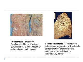 Caseous Necrosis – Tuberculosis
collection of fragmented or lysed cells
and amorphous granular debris
enclosed within a distinctive
inflammatory border
Fat Necrosis – Mesentry
Focal areas of fat destruction,
typically resulting from release of
activated pancreatic lipases
 