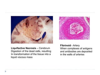 Fibrinoid - Artery
When complexes of antigens
and antibodies are deposited
in the walls of arteries
Liquifactive Necrosis – Cerebrum
Digestion of the dead cells, resulting
In transformation of the tissue into a
liquid viscous mass
 