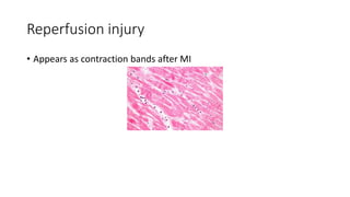 Reperfusion injury
• Appears as contraction bands after MI
 