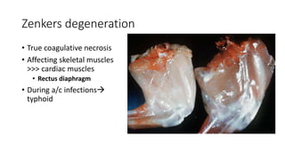 Zenkers degeneration
• True coagulative necrosis
• Affecting skeletal muscles
>>> cardiac muscles
• Rectus diaphragm
• During a/c infections
typhoid
 