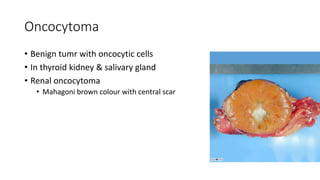 Oncocytoma
• Benign tumr with oncocytic cells
• In thyroid kidney & salivary gland
• Renal oncocytoma
• Mahagoni brown colour with central scar
 