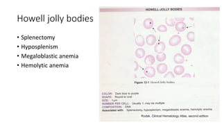 Howell jolly bodies
• Splenectomy
• Hyposplenism
• Megaloblastic anemia
• Hemolytic anemia
 