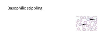 Basophilic stippling
 