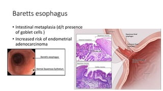 Baretts esophagus
• Intestinal metaplasia (d/t presence
of goblet cells )
• Increased risk of endometrial
adenocarcinoma
 