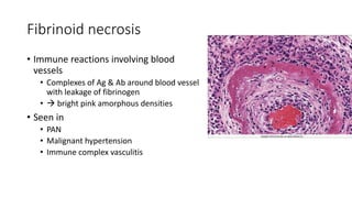 Fibrinoid necrosis
• Immune reactions involving blood
vessels
• Complexes of Ag & Ab around blood vessel
with leakage of fibrinogen
•  bright pink amorphous densities
• Seen in
• PAN
• Malignant hypertension
• Immune complex vasculitis
 