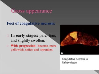 Foci of coagulative necrosis:
In early stages: pale, firm,
and slightly swollen.
With progression: become more
yellowish, softer, and shrunken.
 