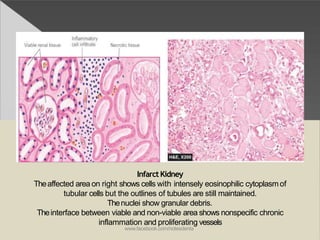 InfarctKidney
Theaffected area on right shows cells with intensely eosinophilic cytoplasmof
tubular cells but the outlines of tubules are still maintained.
Thenuclei show granular debris.
Theinterface between viable and non-viable area shows nonspecific chronic
inflammation and proliferating vessels
www.facebook.com/notesdenta
 