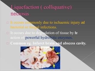 It occurs commonly due to ischaemic injury and
bacterial or fungal infections.
It occurs due to degradation of tissue by the
action of powerful hydrolytic enzymes.
Common eg. Infarct brain and abscess cavity.
 