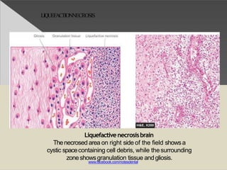 LIQUEFACTIONNECROSIS
Liquefactivenecrosisbrain
Thenecrosed area on right side of the field showsa
cystic spacecontaining cell debris, while thesurrounding
zoneshowsgranulation tissue andgliosis.
www.facebook.com/notesdental
 
