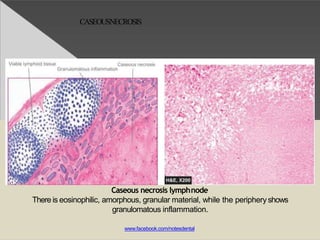 CASEOUSNECROSIS
Caseous necrosis lymphnode
There is eosinophilic, amorphous, granular material, while the peripheryshows
granulomatous inflammation.
www.facebook.com/notesdental
 