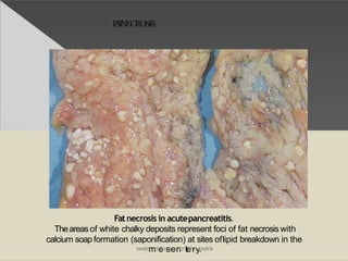 FATNECROSIS
Fatnecrosis in acutepancreatitis.
Theareas of white chalky deposits represent foci of fat necrosis with
calcium soapformation (saponification) at sites oflipid breakdown in the
www.facmebeooske.cnomte/nroyt.esdenta
 