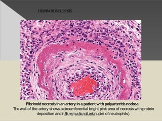 FIBRINOIDNECROSIS
Fibrinoidnecrosisin an artery in a patientwith polyarteritisnodosa.
Thewall of the artery shows acircumferential bright pink area of necrosis withprotein
deposition and inwfwlawm.facmebaootkio.conm(/dnoaterskdennutacllei of neutrophils).
 