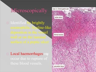 Identified by brightly
eosinophilic, hyaline-like
deposition in the vessel
wall or on the luminal
surface of a peptic ulcer
Local haemorrhages may
occur due to rupture of
these blood vessels.
 